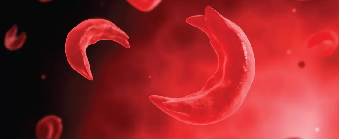 Sickle Cell Cure 2026: Inside the Gene Therapy Breakthrough Giving Patients Their Lives Back